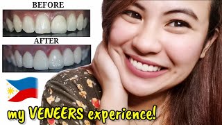 Dental Crown/Jacket to Porcelain VENEERS (SMILE MAKEOVER) - How Much in Philippines? | magnifishe