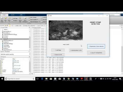 kidney stone in matlab code