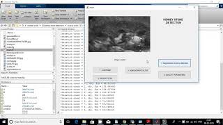 kidney stone in matlab code