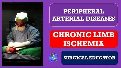 CHRONIC LOWER LIMB ISCHEMIA -  How To DIAGNOSE & TREAT/ Peripheral Arterial Diseases