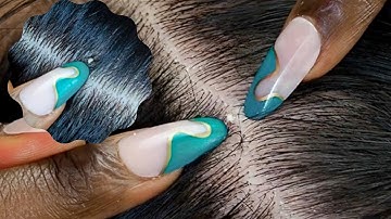 ASMR 1HR Nitpicking | Upclose Allzoomed | Super Attentive ~ silent 😮‍💨