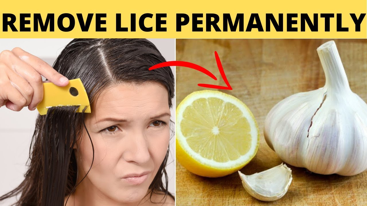 How to Get Rid of Lice Eggs Naturally in One Day with Garlic YouTube