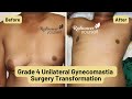 Life-changing surgery for Grade 4 Unilateral Gynecomastia, by expert Cosmetic Surgeon in Pune