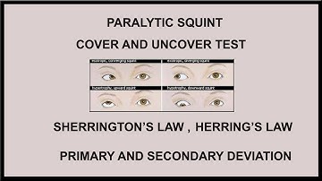 PARALYTIC SQUINT,COVER AND UNCOVER TEST,SHERRINGTON