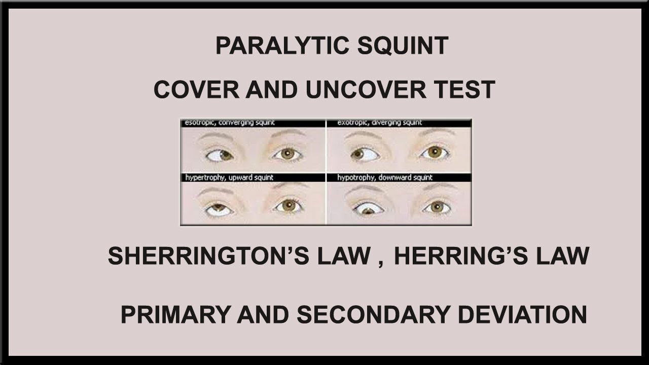 PARALYTIC SQUINT,COVER AND UNCOVER TEST,SHERRINGTON'S LAW,HERRING'S LAW