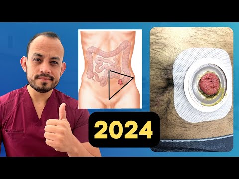 Video: ¿Qué causa que una persona tenga una bolsa de colostomía?