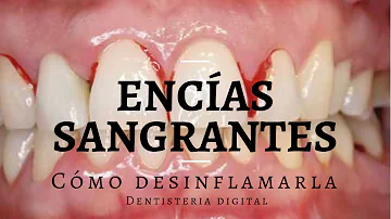 ¿Cuánto tiempo se tarda en revertir la gingivitis?