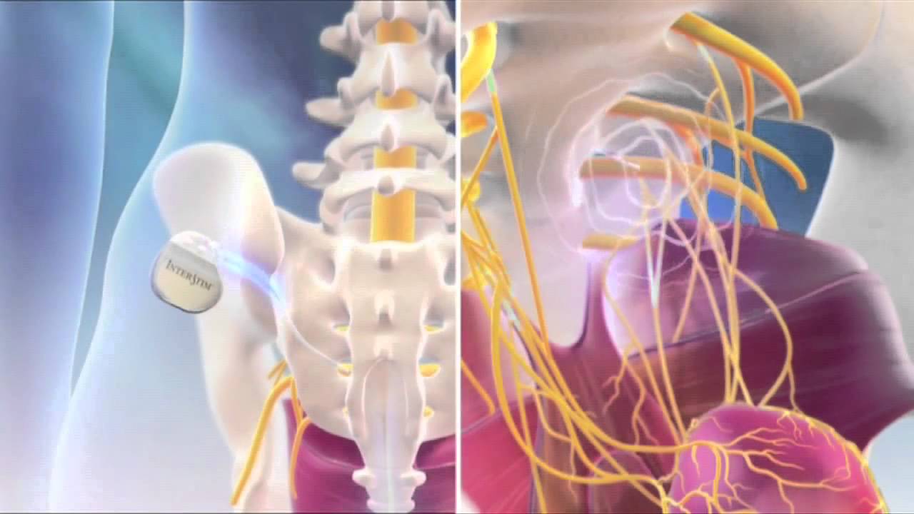 InterStim Therapy - YouTube