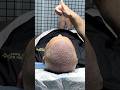 Beard to Scalp 😳 Insane Hair Transplant Transformation By Dr Salman #drsalman