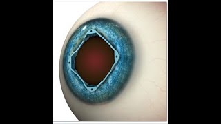 Oasis Iris Expander - Loading Guide