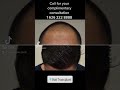 Before and After FUE Hair Transplant in Los Angeles, LA FUE Hair Clinic