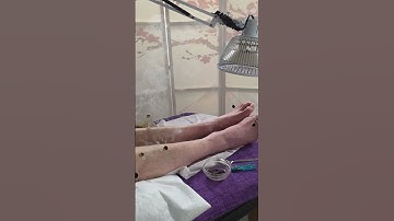 Acupuncture and Moxa post-stroke, Hemiplegic #chinesemedicine #longevity #acupuncture #stroke