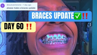 MY BRACES AFTER 60 DAYS‼️😳:PAIN ,CHANGE,ROUTINE 