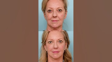 She Wanted to Look Younger, Not Different — See Her Stunning Facelift Reveal #Facelift