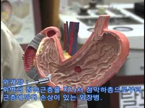 위염과위궤양의차이는무엇인가요.avi