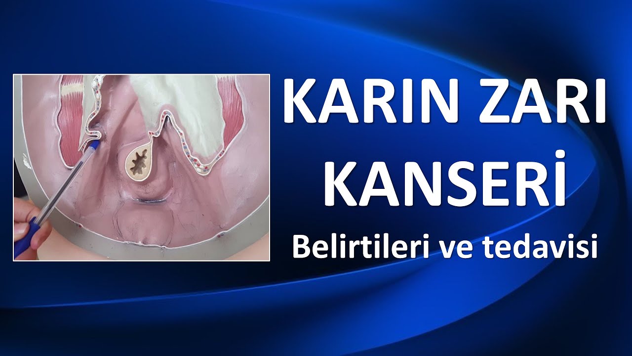karin zari kanseri teshis ve tedavisi youtube karin zari kanseri teshis ve tedavisi youtube