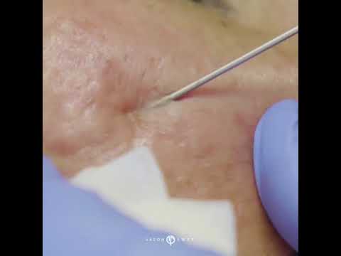 Acne Scar Subcision Treatment with Dr. Jason Emer