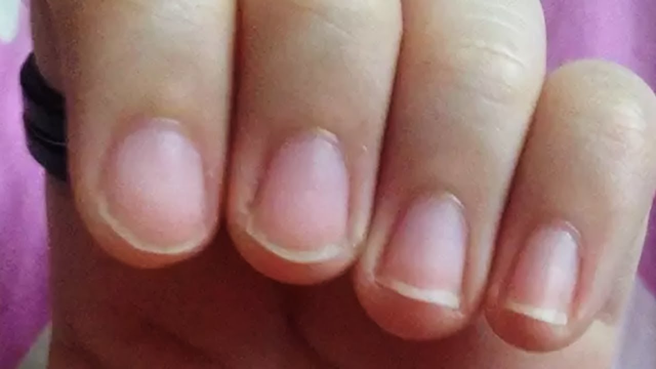 covid 19: Observing changes in fingernails? Red half-moon-shaped marks,  ridges and white lines may be due to Covid - The Economic Times