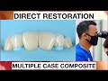 Step by step layering anterior multiple case composite  general dentist griya rr