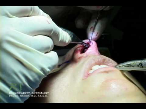Video thumbnail: Dr. Nassif's Closed Rhinoplasty How To - Columellar Strut · NassifMD®