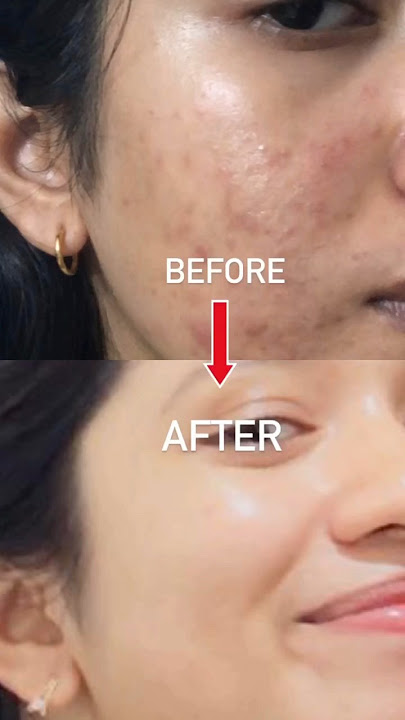 1 PRODUCT Changed ACNE TO CLEAR SKIN JOURNEY🤍🥺With in 2 month#acne
