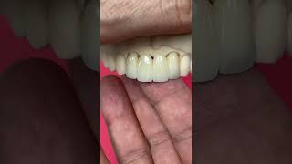 Anterior Pontic Bridge @EnvisiontecMain #envisiontec