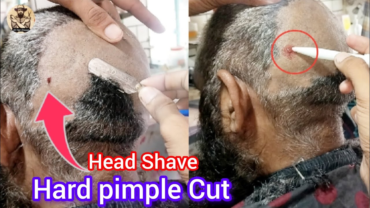 head-shave-tutorial-how-to-full-attractive-hard-pimples-remove-head
