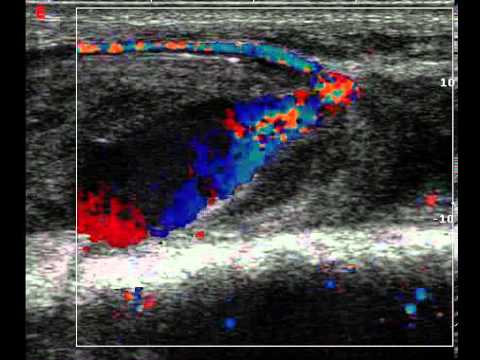 Radial Artery Pseudoaneurysm Youtube Radial Artery Pseudoaneurysm Youtube