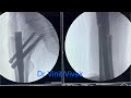 Complex fracture surgery #fracture #bone #trauma #pain #patient
