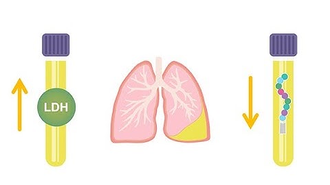 Differentiating transudative and exudative effusions transudate vs  exudate