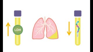 Differentiating transudative and exudative effusions transudate vs  exudate