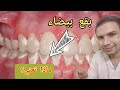 ماذا يعني وجود بقع بيضاء علي سطح الاسنان العلاج السريع و الفعال
