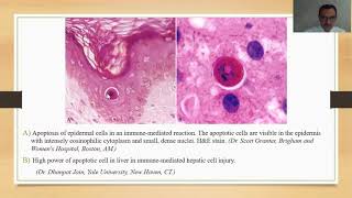 Cell death: Necrosis and Apoptosis. Death of human. Mortal signs