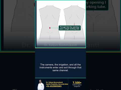 The Whole Spine Operation Through an 8mm Cut — Best Endoscopic Spine Surgeon, Hyderabad