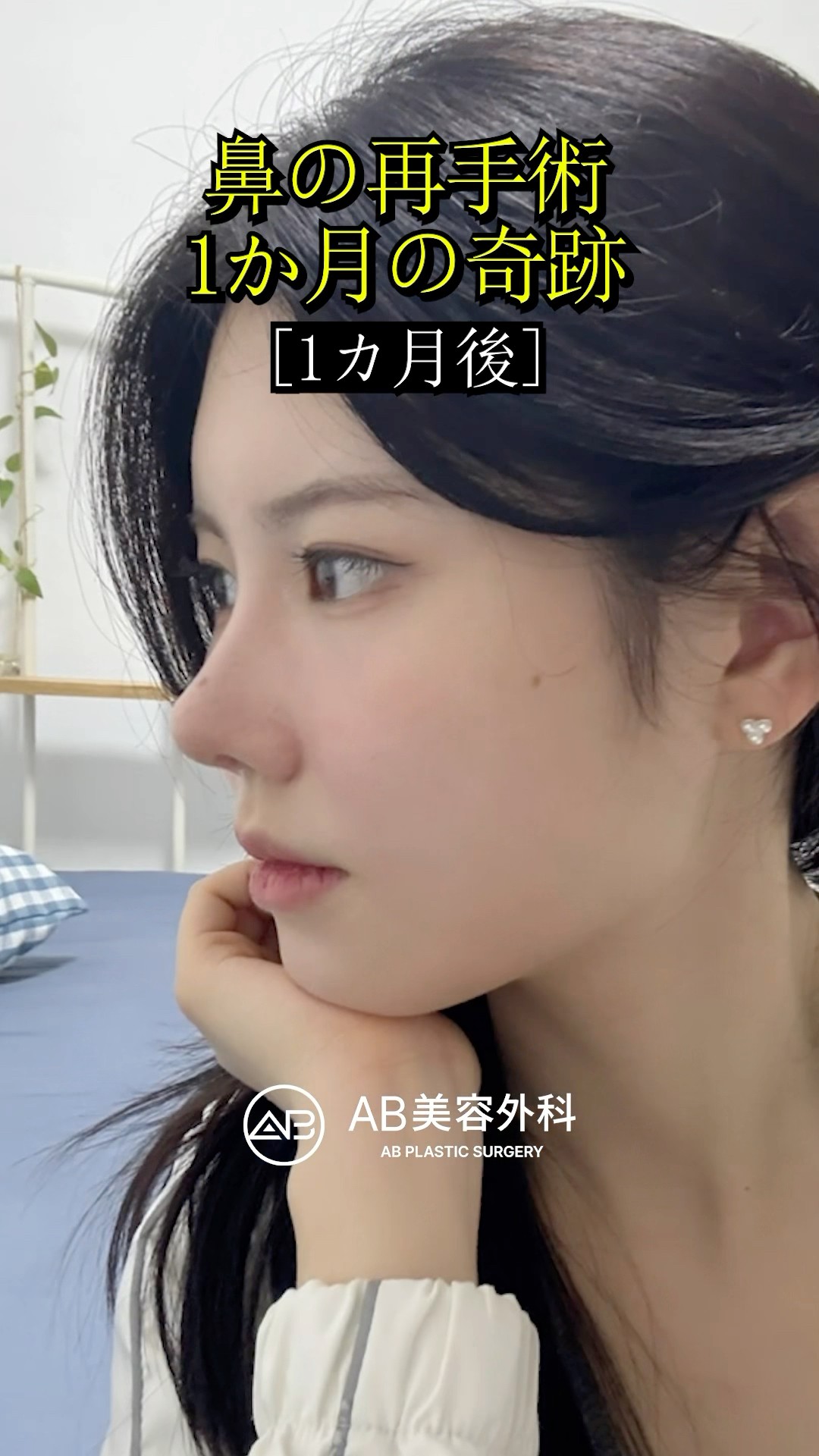 前回は自然すぎた…再手術で大満足 #shorts