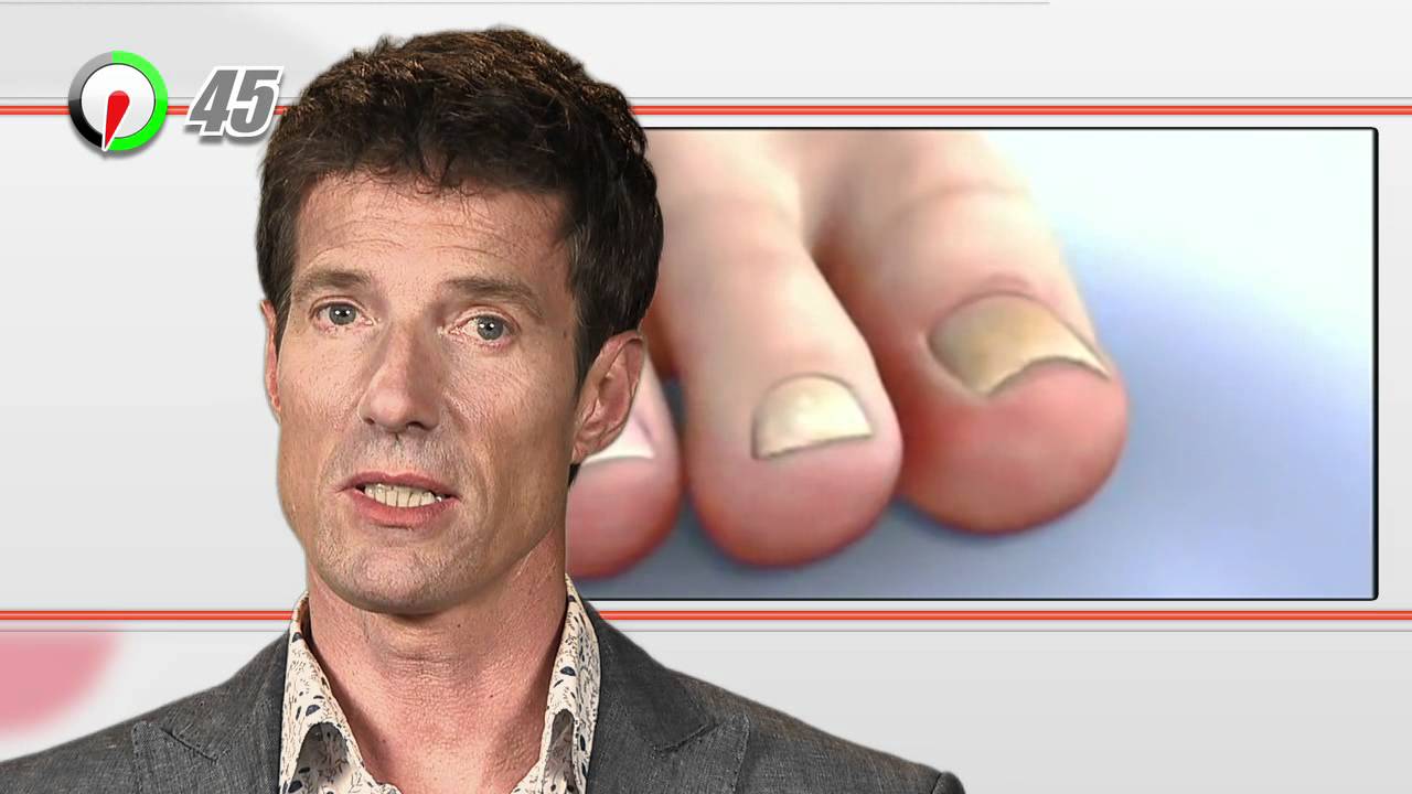 Kalknagel 100 Seconden Dokter YouTube Kalknagel 100 seconden dokter youtube
