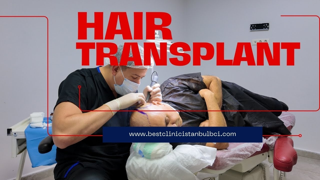 Full Hair Transplant Journey in Istanbul | From Hospital Tour to Final Results at Best Clinic