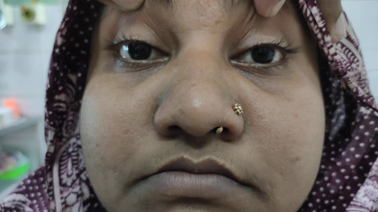 Relative Afferent Pupillary Defect (RAPD) - YouTube
