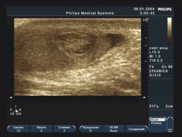 Перекрут гидатиды придатка яичка