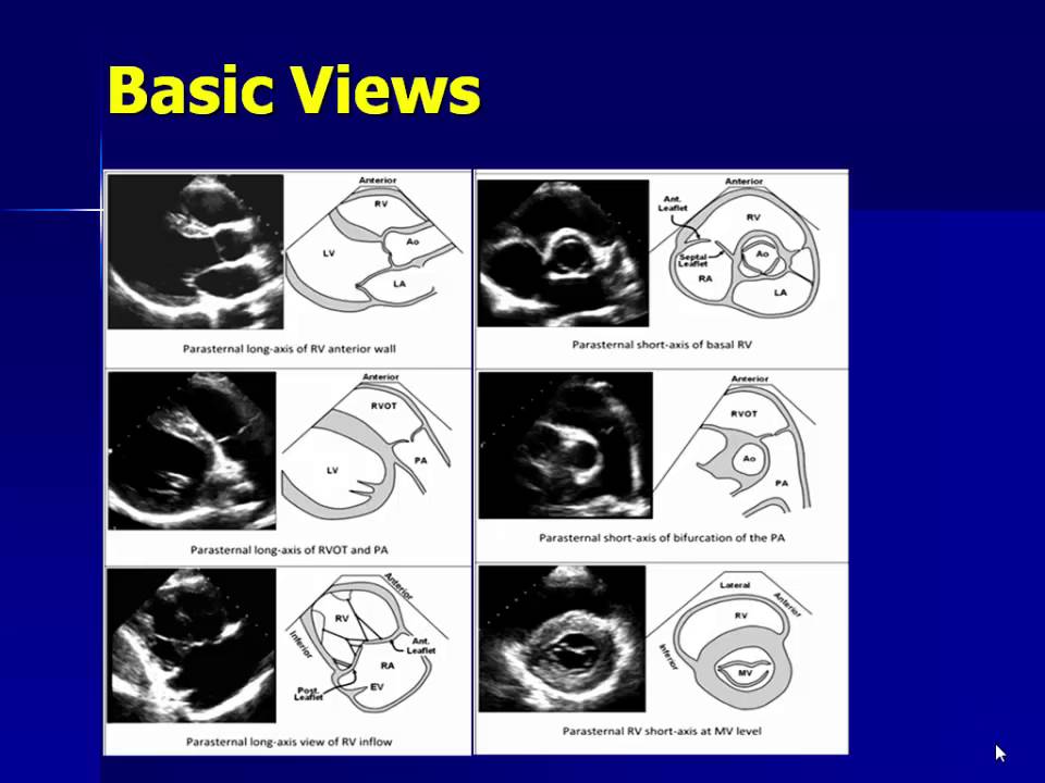 Echocardiography Of The Right Ventricle YouTube echocardiography-of-the-right-ventricle-youtube