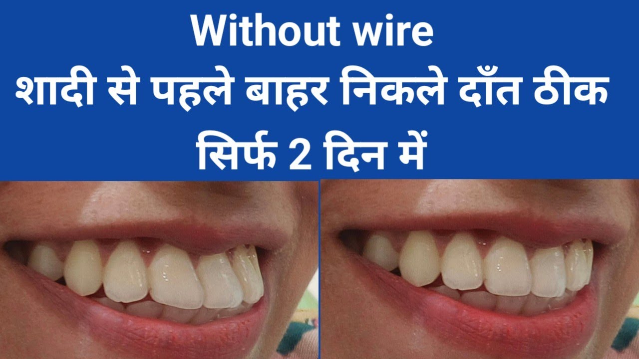 बिना तार बाहर निकले दाँतों का इलाज | No Braces Smile Design | शादी से पहले बाहर निकले दाँतों का इलाज