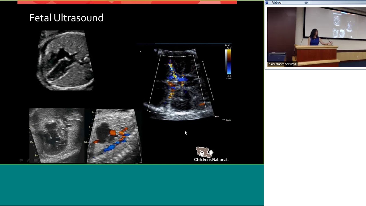 Cardiac Neurodevelopmental Connection Critical Information for Parents of CHD Warriors