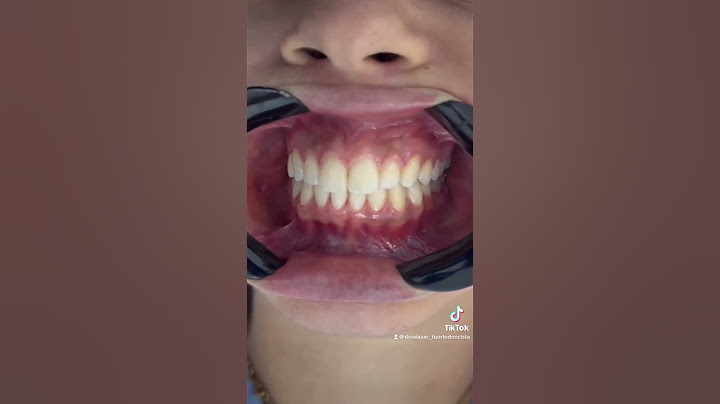 Adiós brackets bienvenida nueva sonrisa