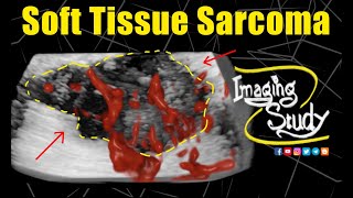 Soft Tissue Sarcoma || Ultrasound || Case 321 screenshot 4