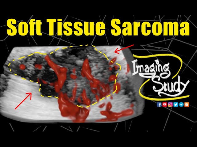 Soft Tissue Sarcoma || Ultrasound || Case 321 - YouTube