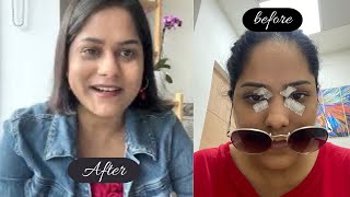 Cholesterol deposit surgery me kitna paisa laga? | Xanthelasma Removal Surgery Before & After