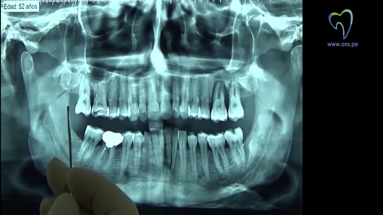 Cómo leer una radiografía panorámica YouTube