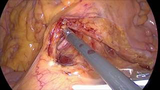 low anterior resection laparscopic