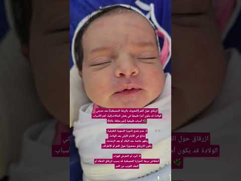 ازرقاق حول الفم في حديث الولادة  