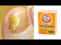 How to get rid of toenail fungus naturally fast in 2 day with baking soda | Nail fungus treatment